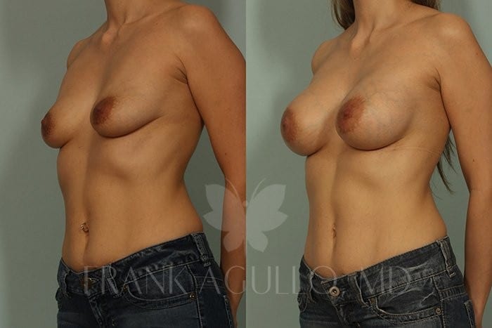 Breast Augmentation Before and After 3
