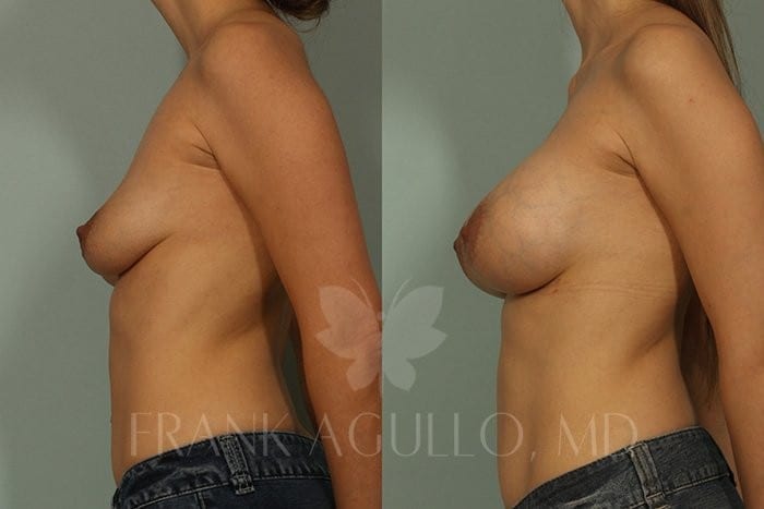 Breast Augmentation Before and After 5
