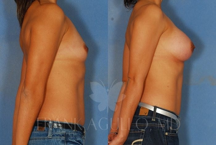 Breast Augmentation Before and After 3