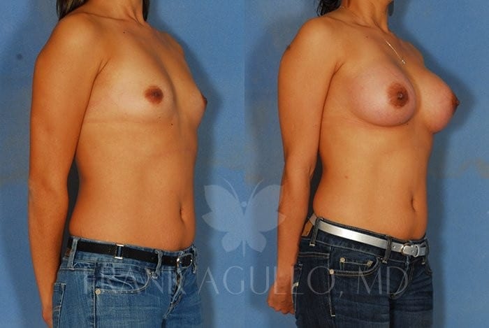 Breast Augmentation Before and After 2
