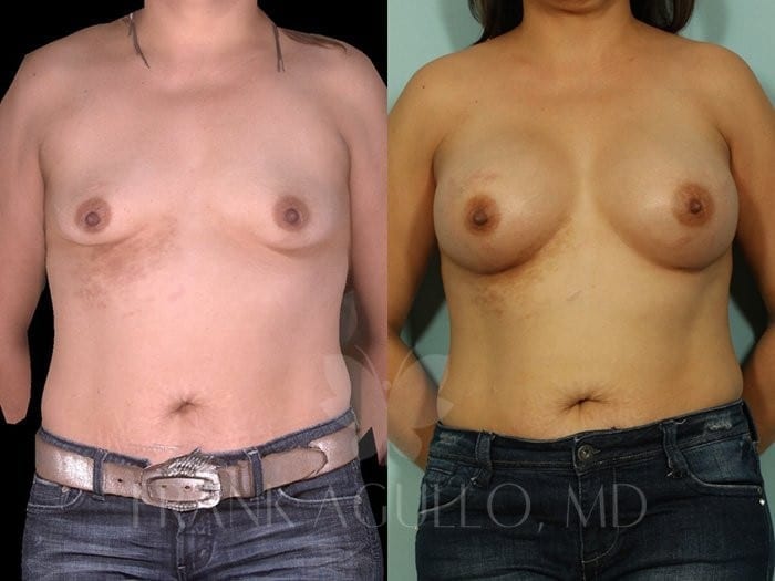 Breast Augmentation Before and After 7