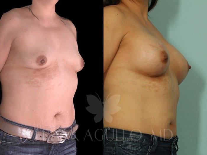 Breast Augmentation Before and After 2