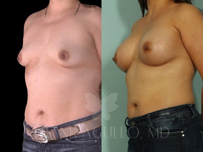 Breast Augmentation Before and After 3