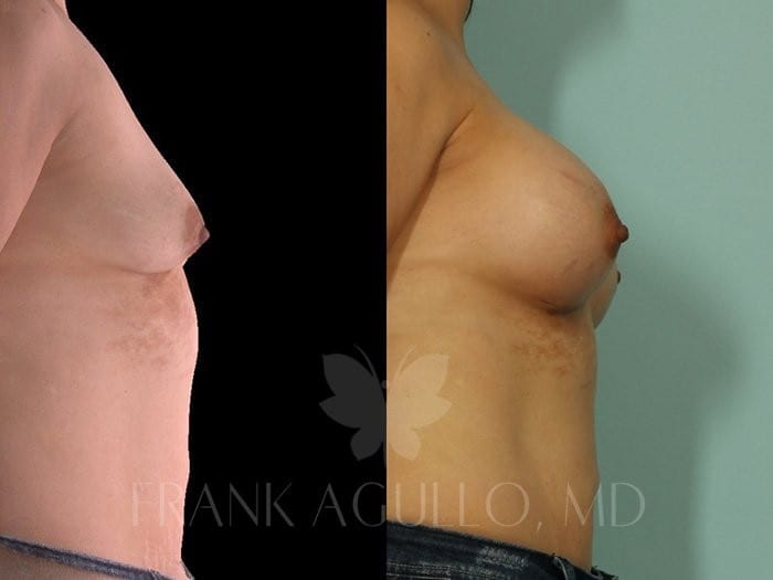 Breast Augmentation Before and After 4