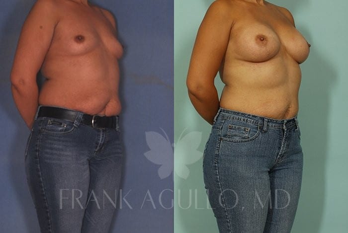 Breast Augmentation Before and After 6