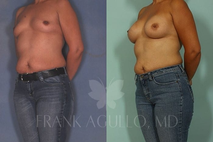 Breast Augmentation Before and After 2