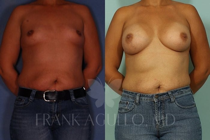 Breast Augmentation Before and After 3