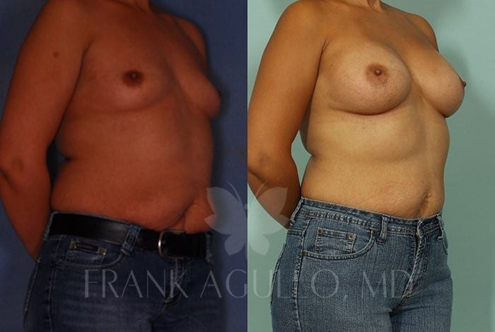 Breast Augmentation Before and After 4