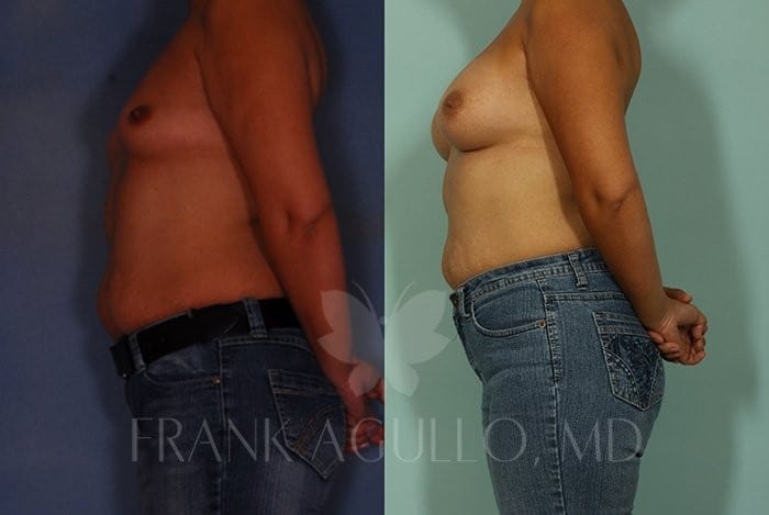 Breast Augmentation Before and After 5