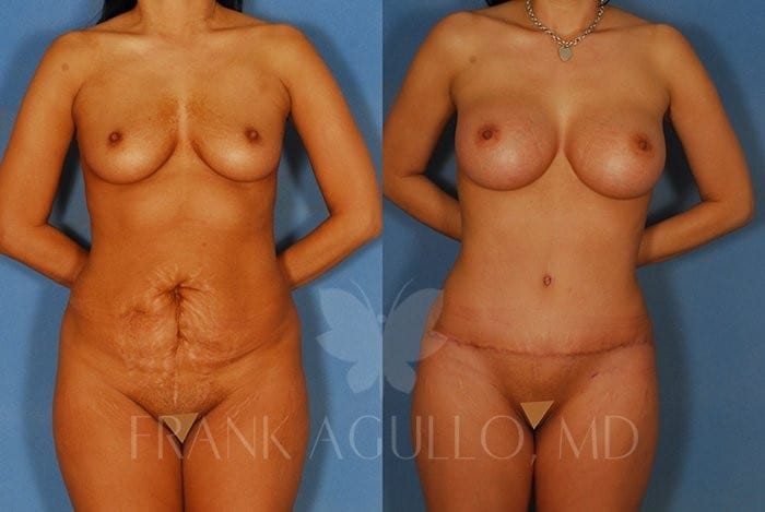 Breast Augmentation Before and After 4