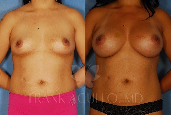 Breast Augmentation Before and After 3