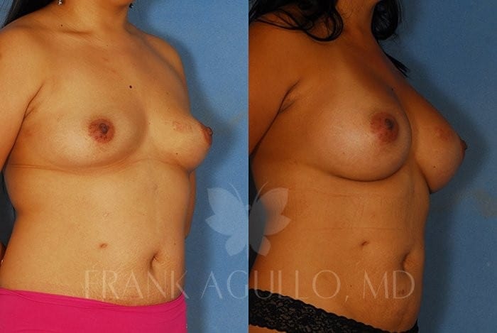 Breast Augmentation Before and After 2