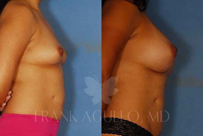 Breast Augmentation Before and After 5