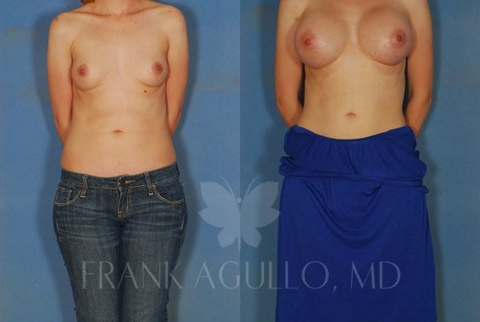 Breast Augmentation Before and After 4