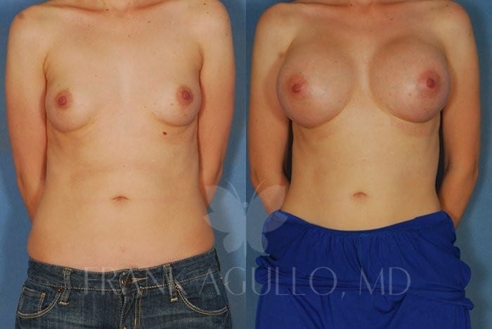 Breast Augmentation Before and After 3