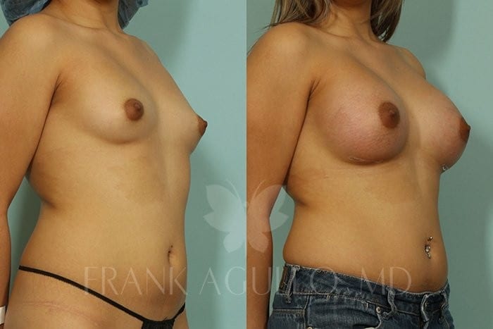 Breast Augmentation Before and After 3