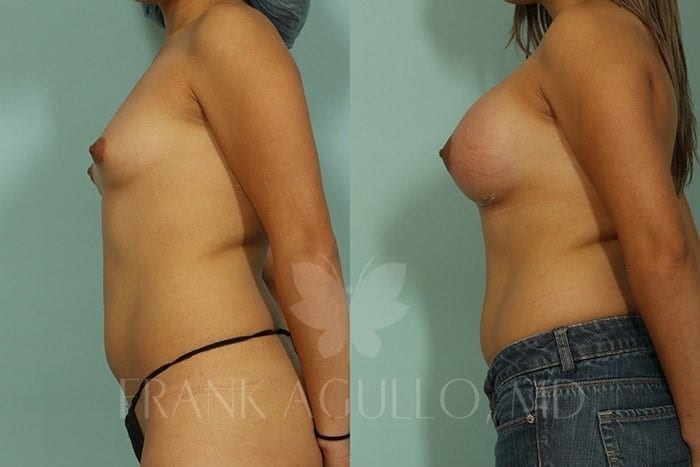 Breast Augmentation Before and After 4