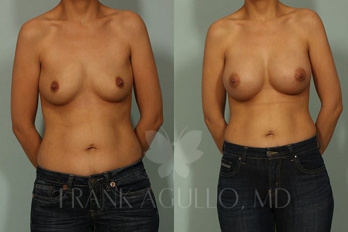 Breast Before and After 11