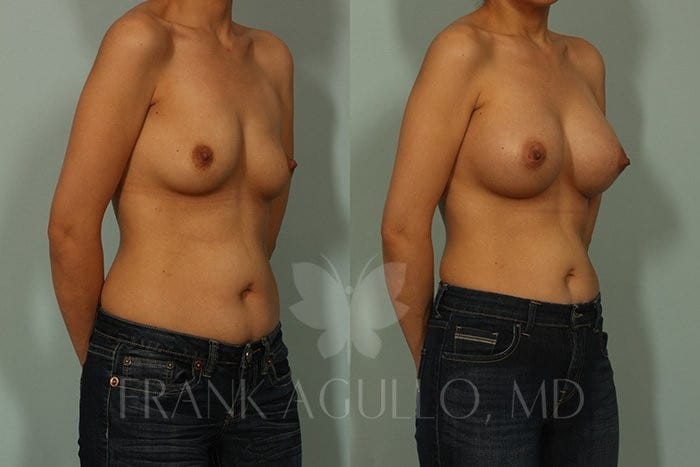 Breast Augmentation Before and After 2