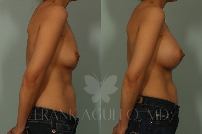 Breast Augmentation Before and After 3