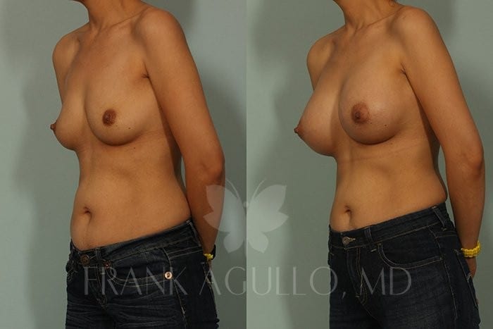 Breast Augmentation Before and After 4