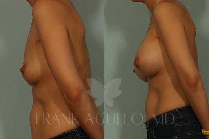 Breast Augmentation Before and After 5
