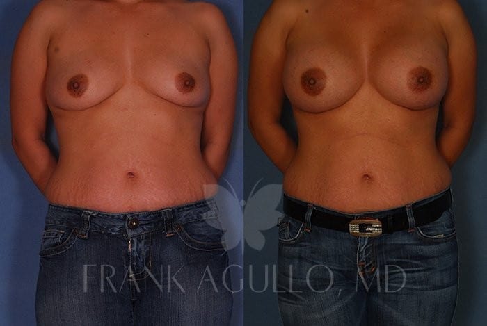 Breast Augmentation Before and After 18