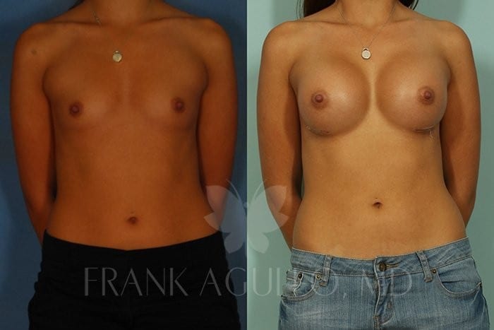 Breast Augmentation Before and After 5
