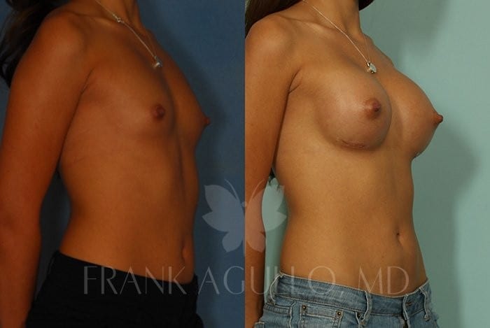 Breast Augmentation Before and After 4