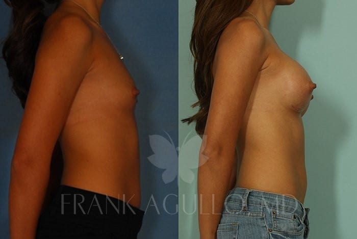 Breast Augmentation Before and After 3