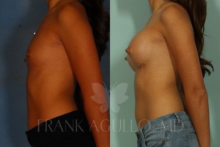 Breast Augmentation Before and After 2