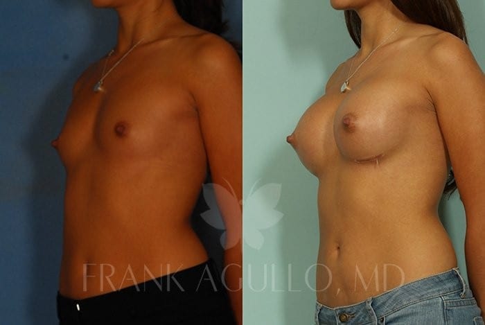 Breast Before and After 7