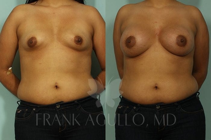 Breast Augmentation Before and After 15