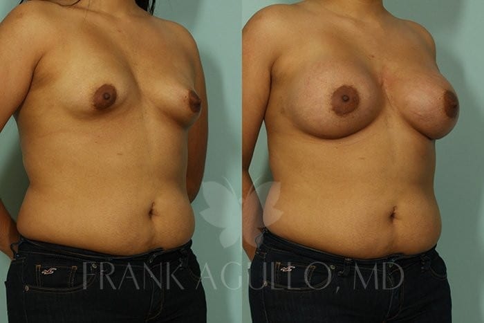 Breast Augmentation Before and After 2