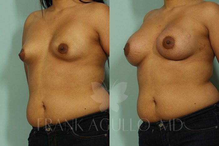 Breast Augmentation Before and After 3