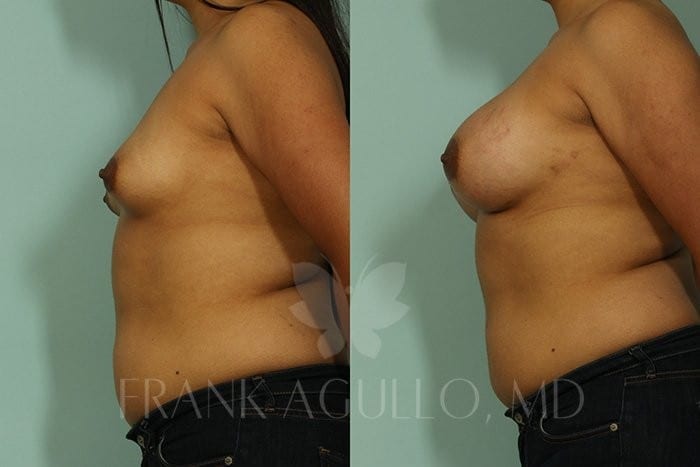 Breast Augmentation Before and After 4