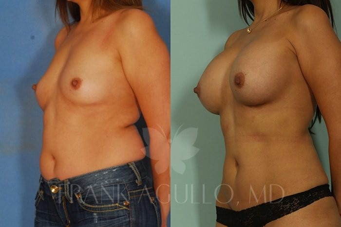 Breast Augmentation Before and After 2
