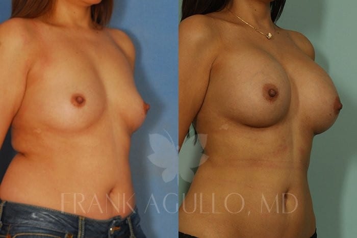 Breast Augmentation Before and After 3