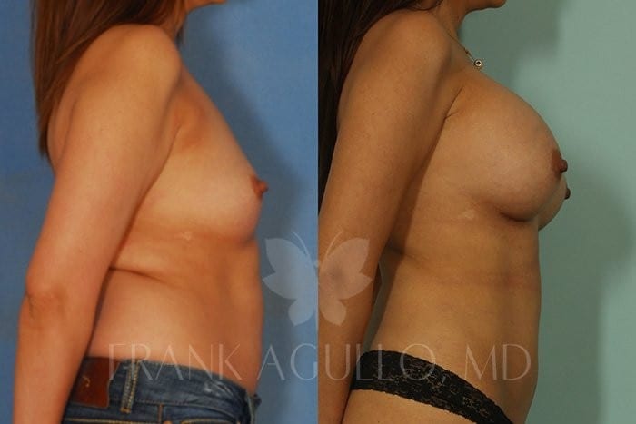 Breast Augmentation Before and After 4
