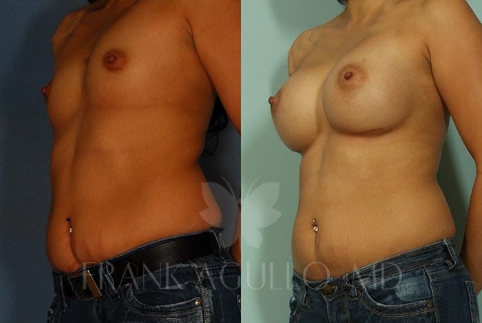Breast Augmentation Before and After 2