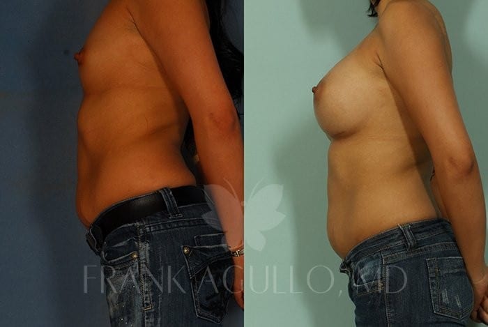 Breast Augmentation Before and After 3