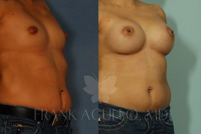 Breast Augmentation Before and After 4