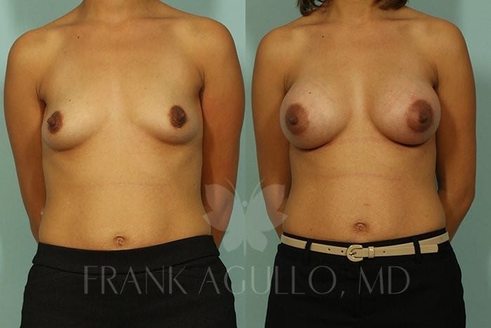 Breast Before and After 3