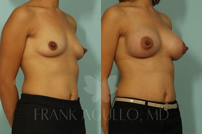 Breast Augmentation Before and After 2