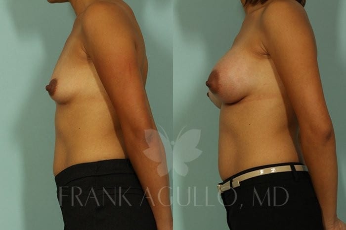 Breast Augmentation Before and After 4