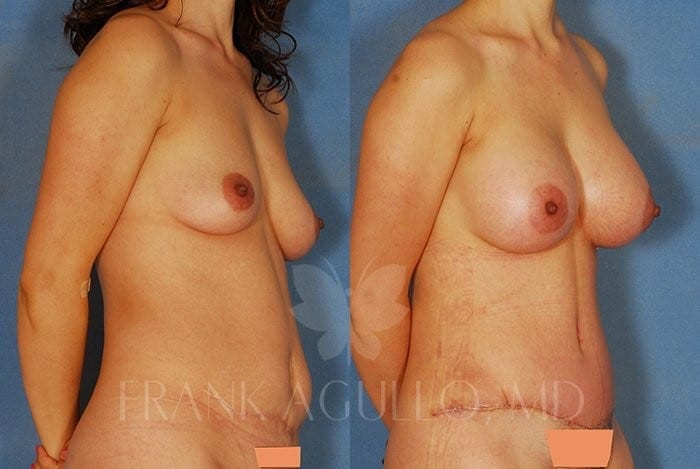 Breast Augmentation Before and After 3