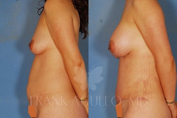 Breast Augmentation Before and After 4