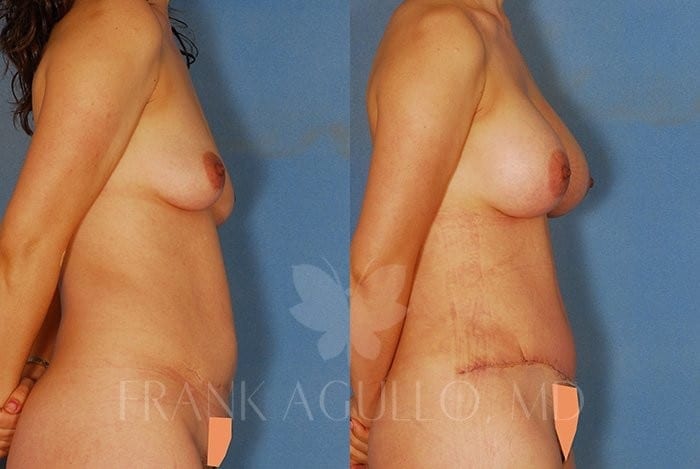 Breast Augmentation Before and After 5