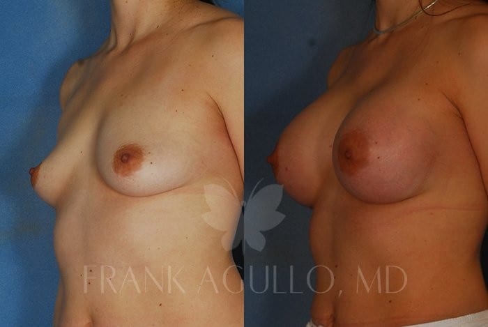 Breast Before and After 1