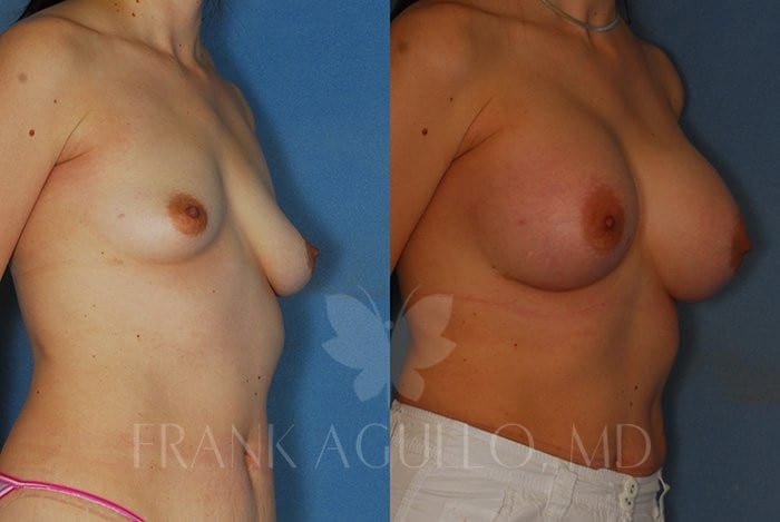 Breast Augmentation Before and After 2